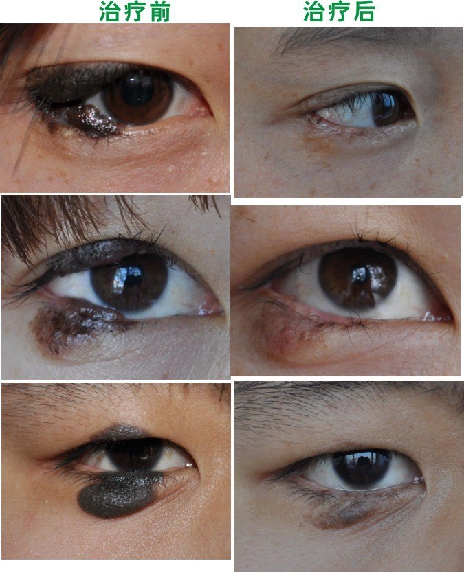 眼睑色素瘤图片