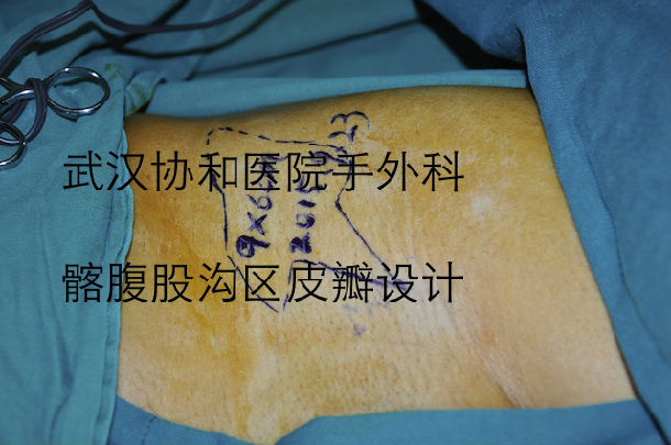 2015年9月23日完成的一例髂腹股沟皮瓣重建手掌的手术