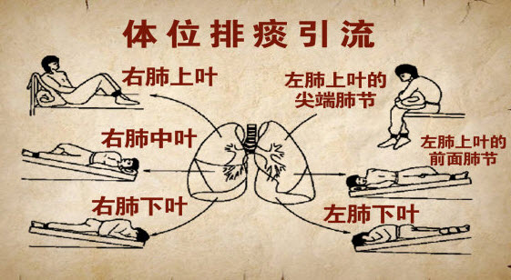 慢性阻塞性肺疾病(copd)康復技術之四:體位引流