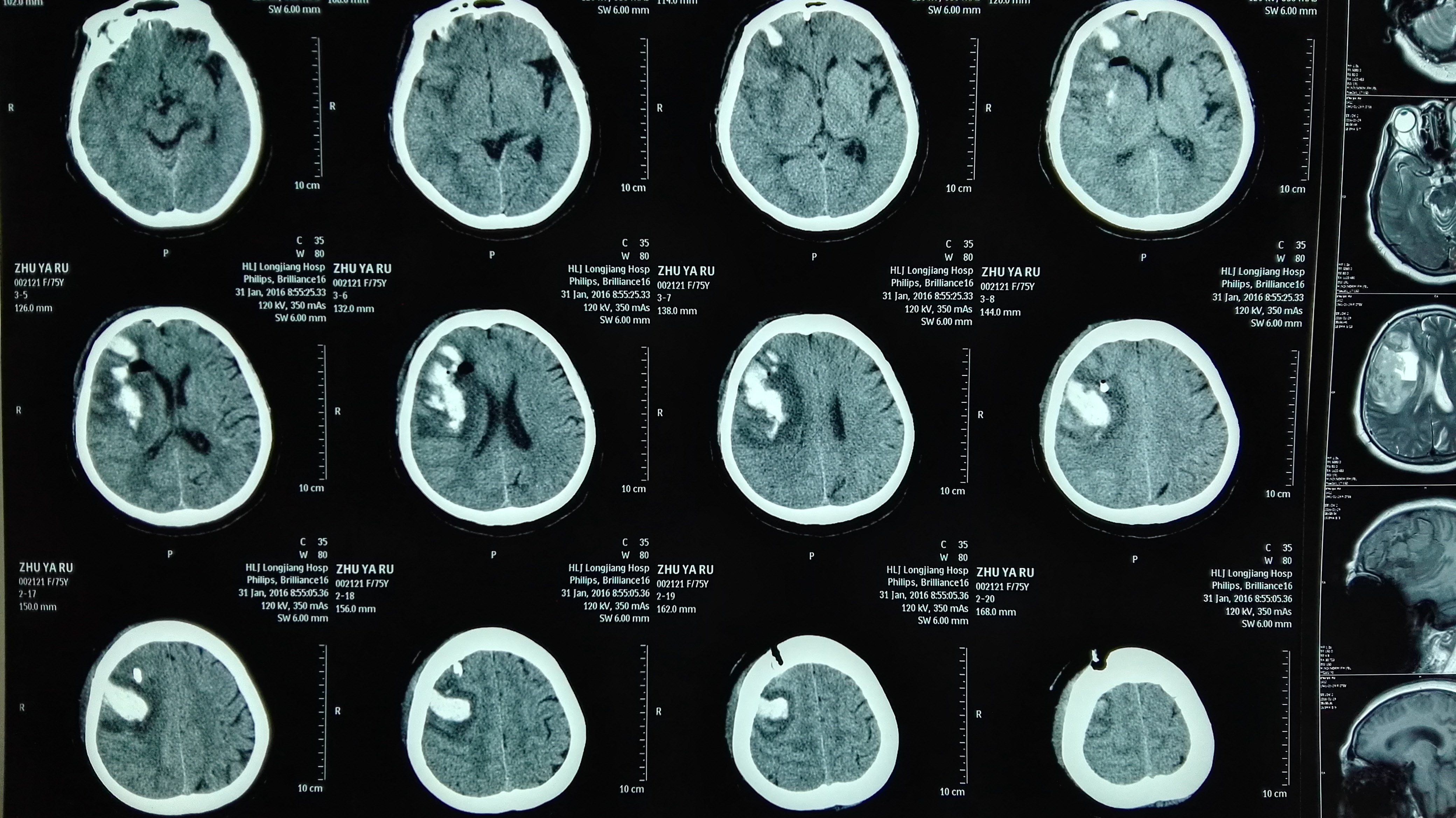 烟雾病待除外急诊予以脑出血钻孔引流术后头部ct显示中线结构恢复两日