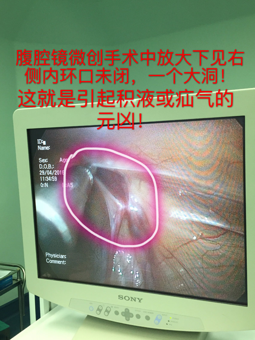 鞘膜积液手术图谱图片