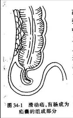疝——嵌顿的疝内容物为肠管壁的一部分也称为肠管壁疝(3) littre 疝
