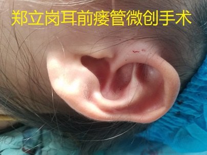 鄭立崗耳前瘻管微創手術第103廣東佛山南海關