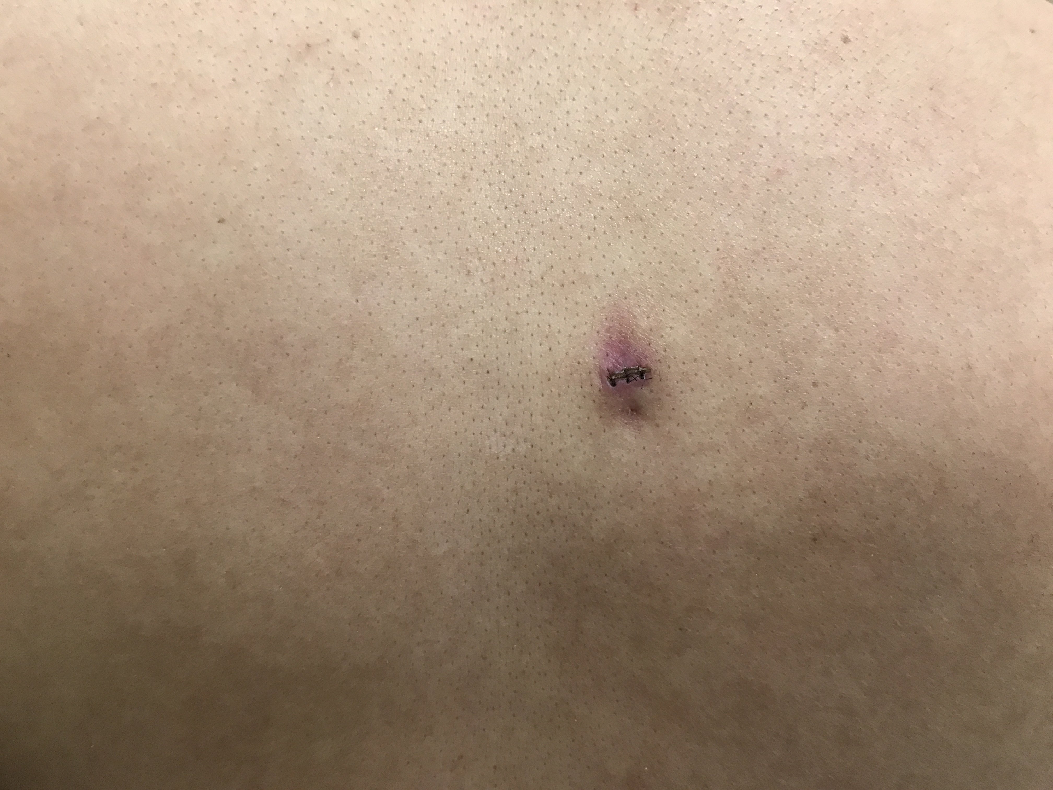 小切口皮脂腺囊肿术后10天拆线关于拆线的三个最常见问题:一,常规拆线