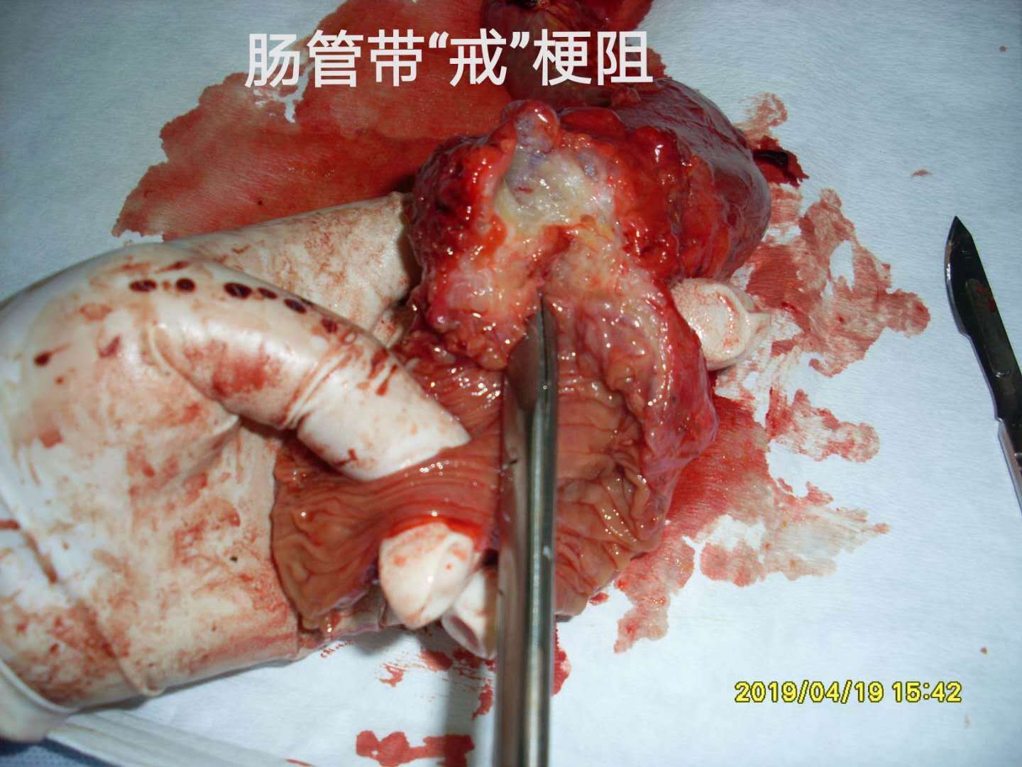 病例46腹水查因pmp姑息crs后一年再次手术