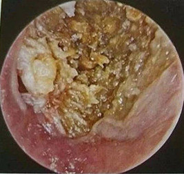 外耳道乳头状瘤图片