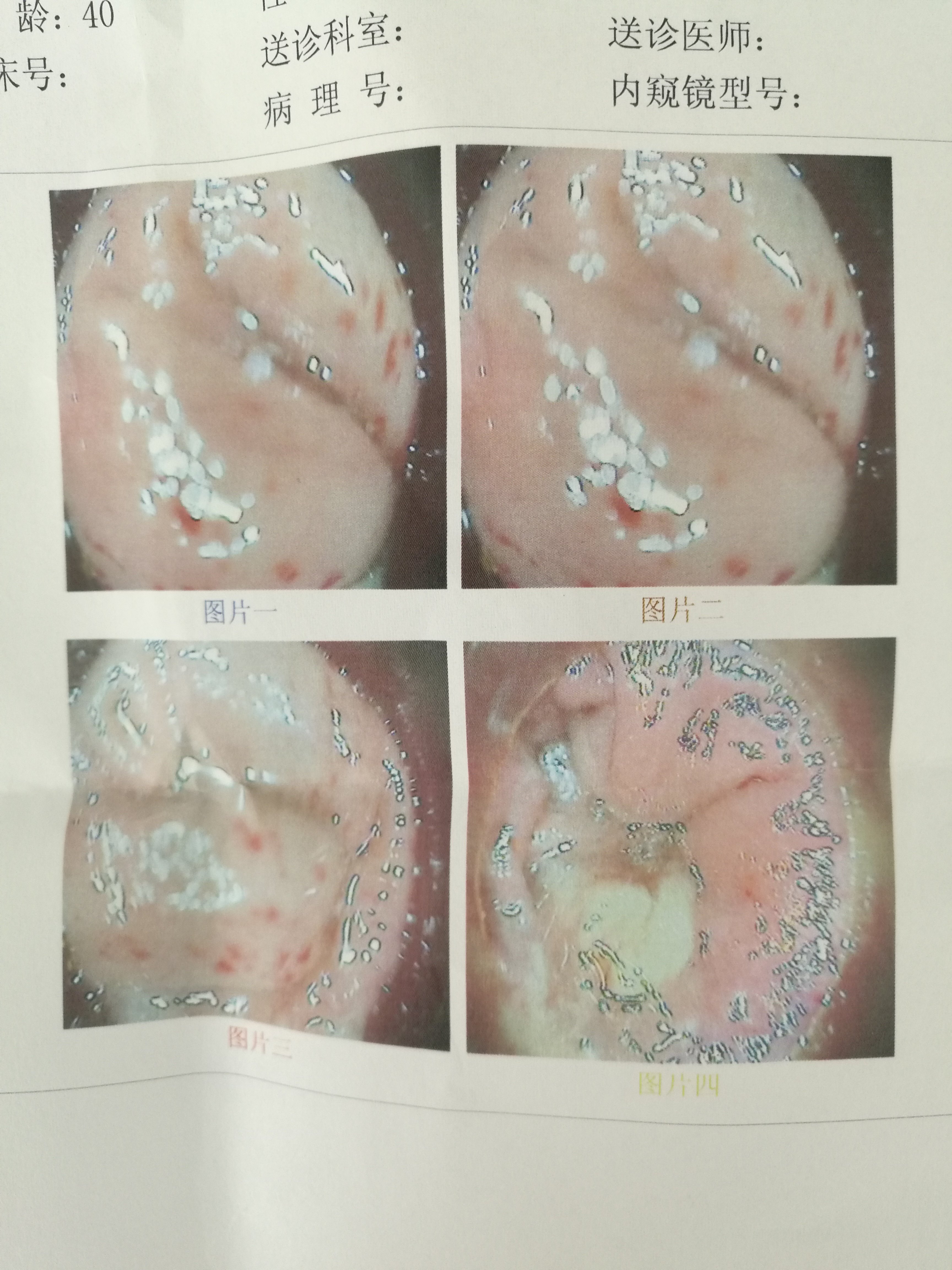 肠镜有死角看病需谨慎