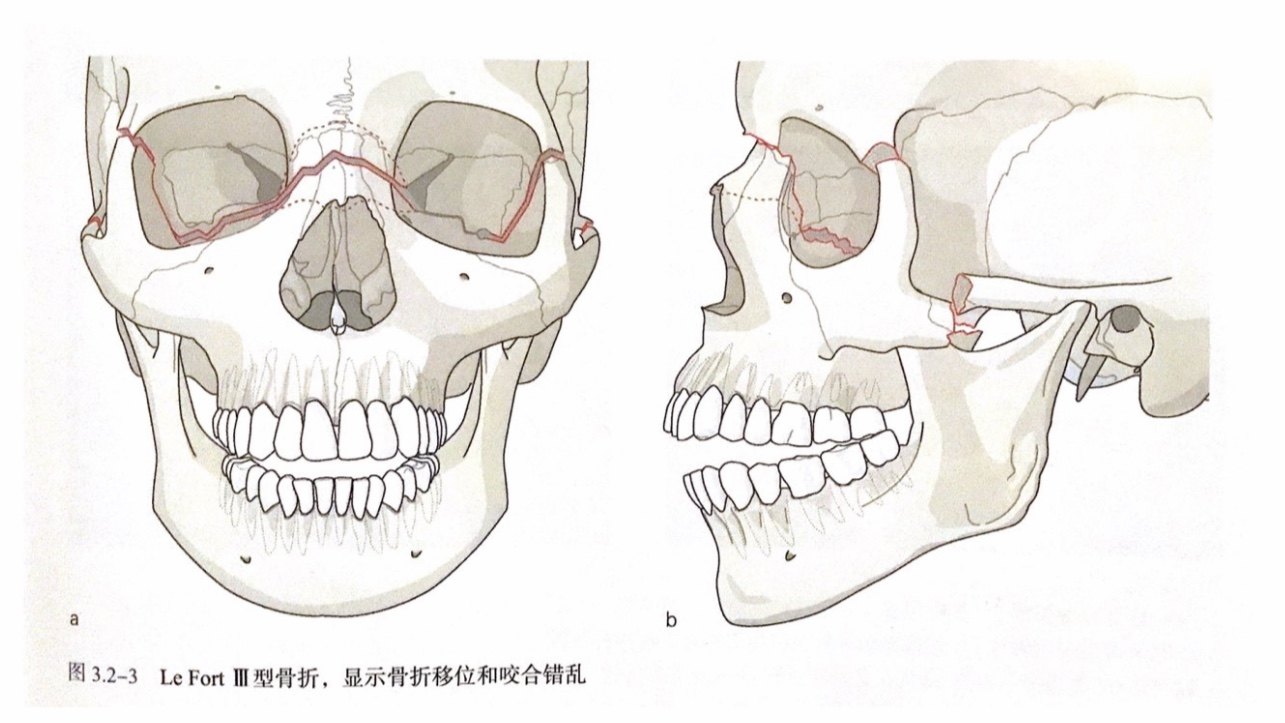 图4 le fort iii型骨折所以,我认为,常规的正颌手术属于三级手术.