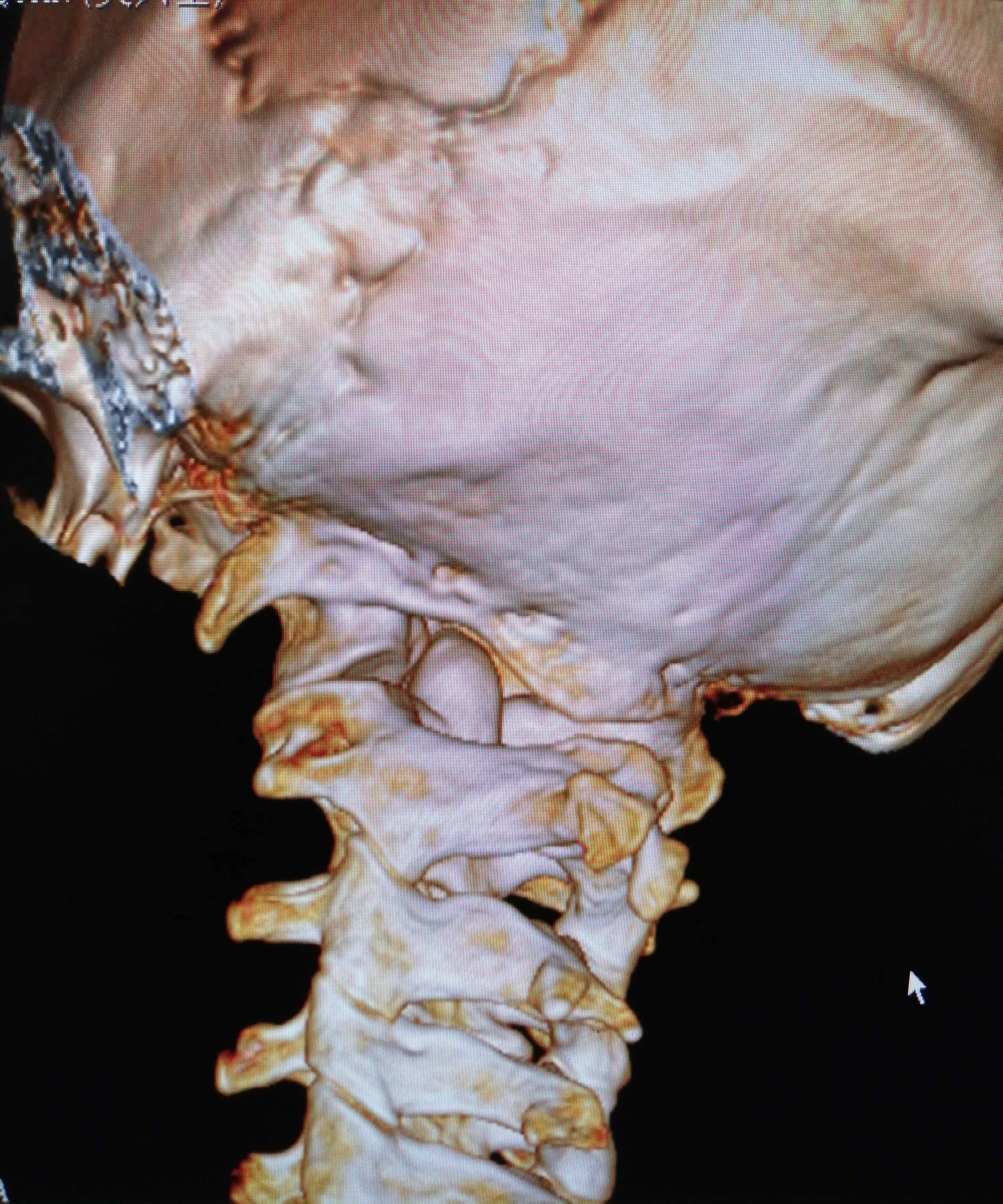 病例:颈部疼痛伴双上肢麻木,原来是寰枢椎失稳症! 