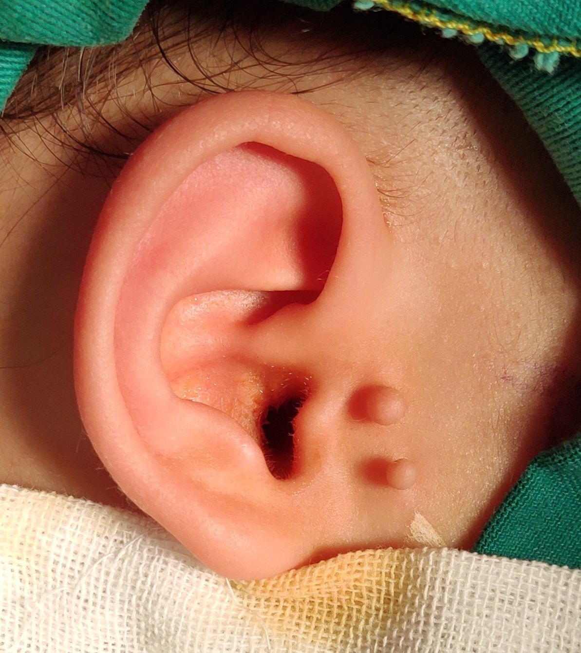 秦昊医生手记_20190130双侧副耳切除 - 好大夫在线