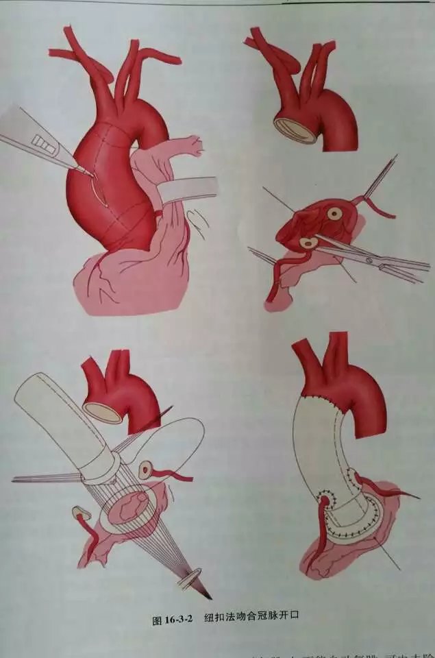 主动脉根部置换术(bentall手术) - 好大夫在线