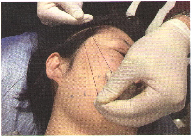 多次线雕以后是不是不能做面部提升了呢?