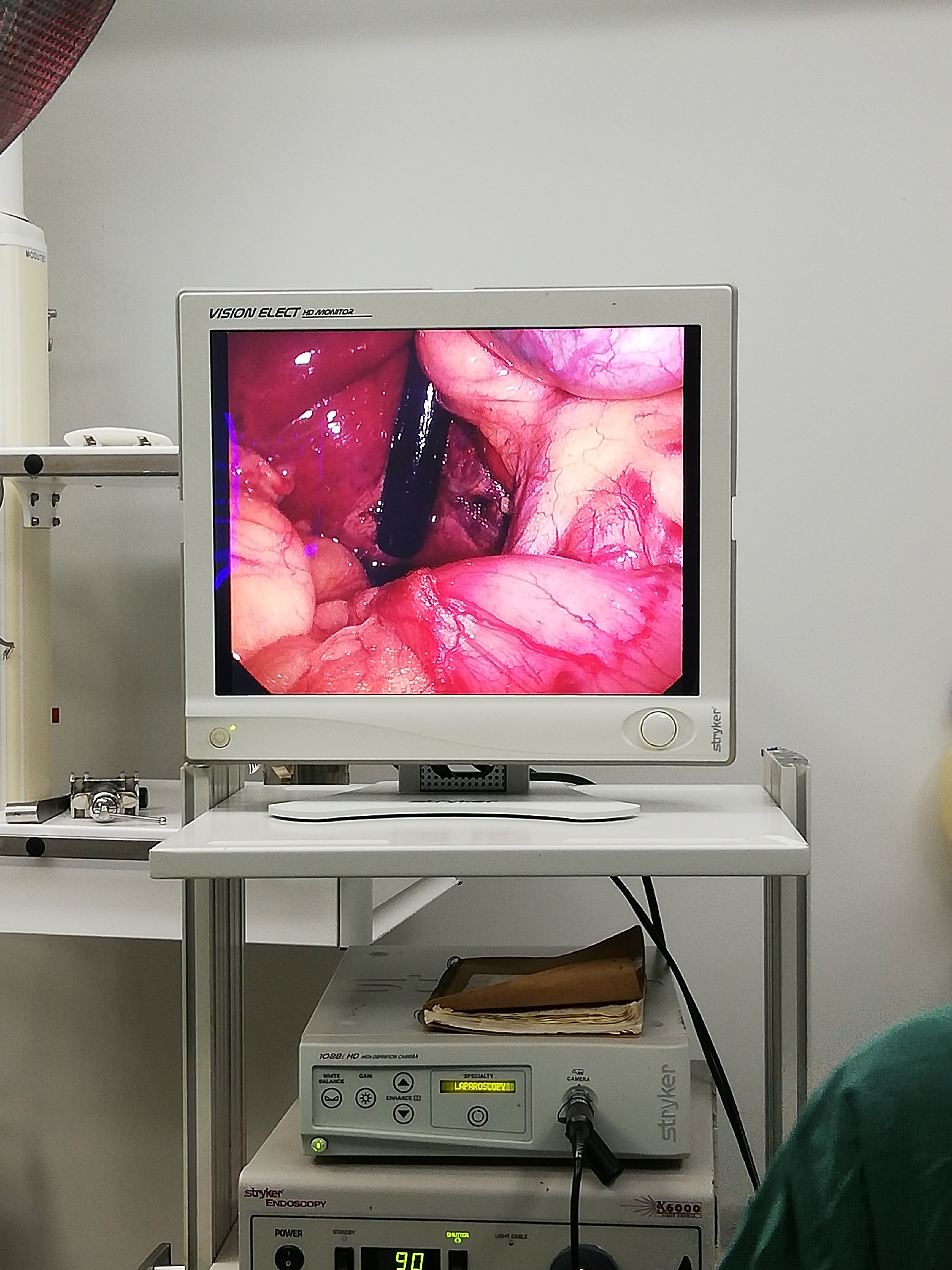 肝右后叶慢性脓肿的腹腔镜开窗引流及肝顶部结节切除 - 好大夫在线