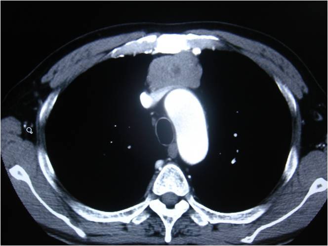 關注包括胸內甲狀腺腫畸胎瘤胸腺瘤縱隔囊腫神經源性腫瘤