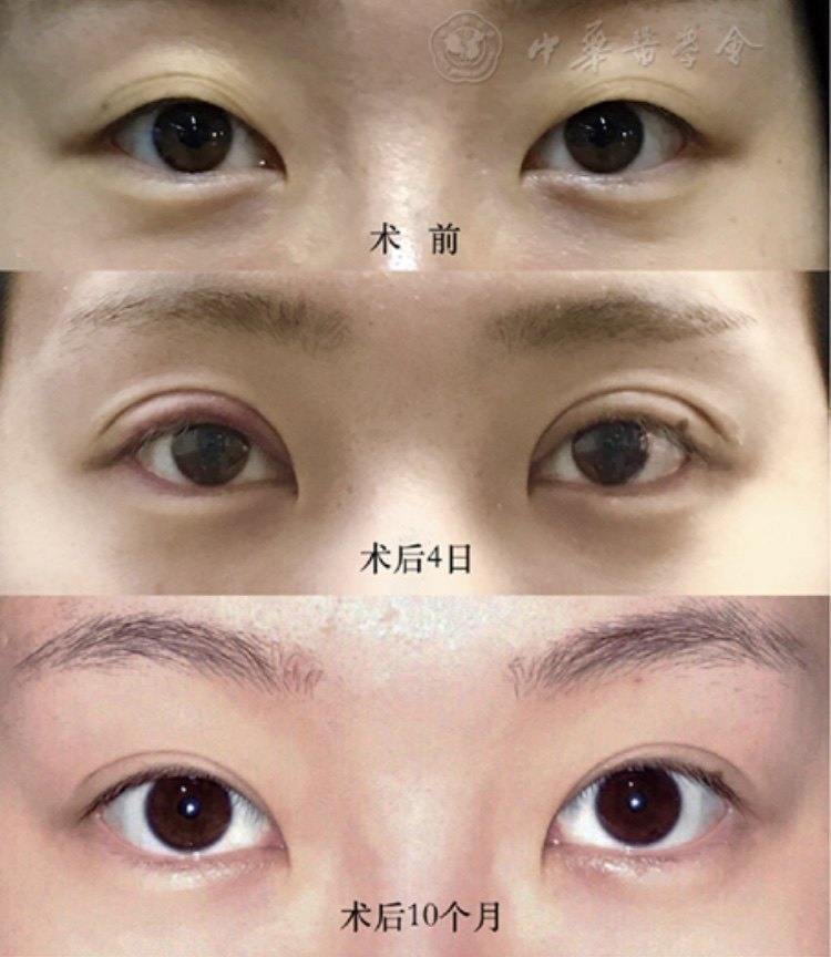 改良三点微创重睑术 - 好大夫在线