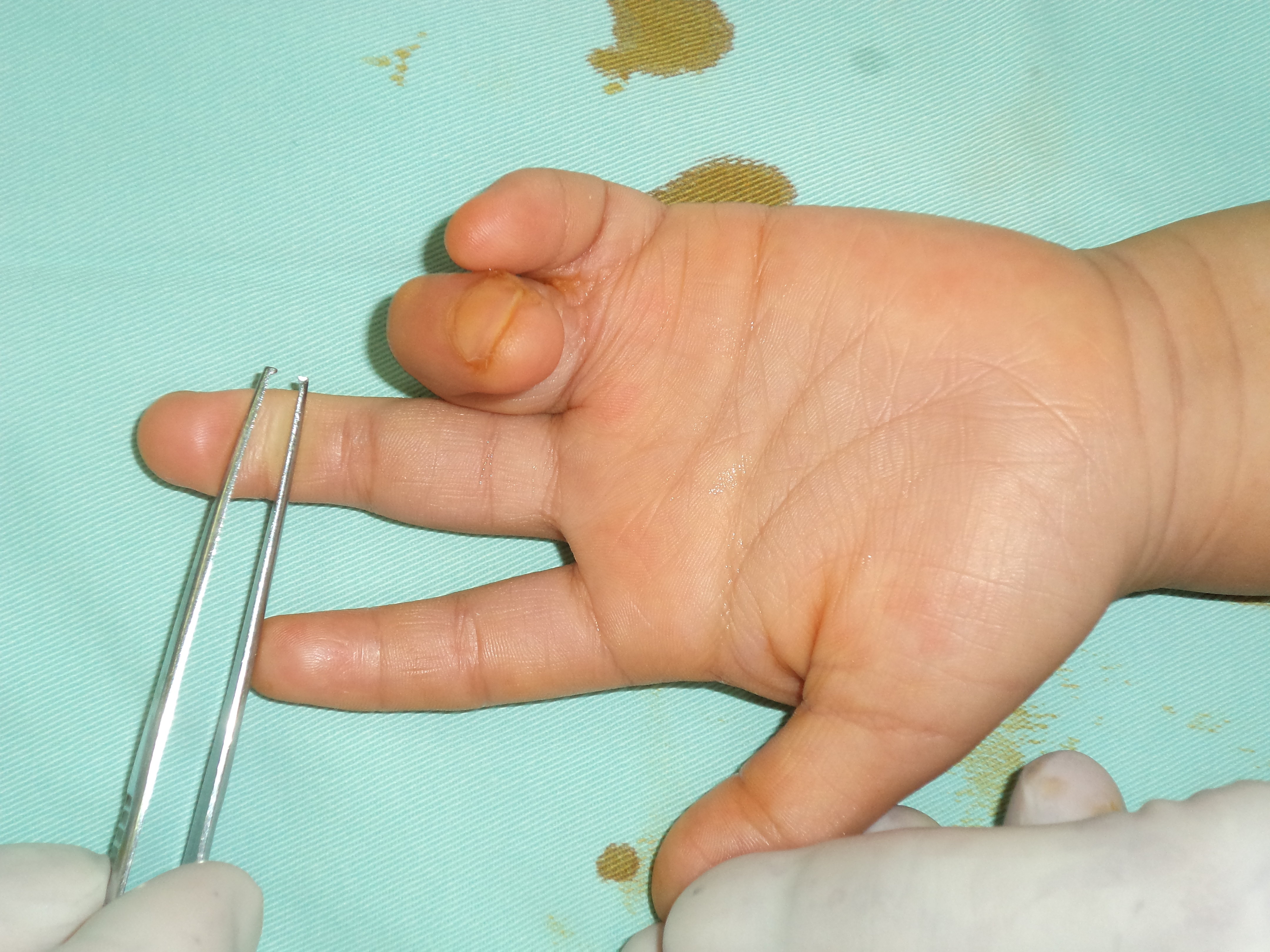 小儿四肢(趾)指先天畸形多大年龄治疗合适? - 好大夫在线