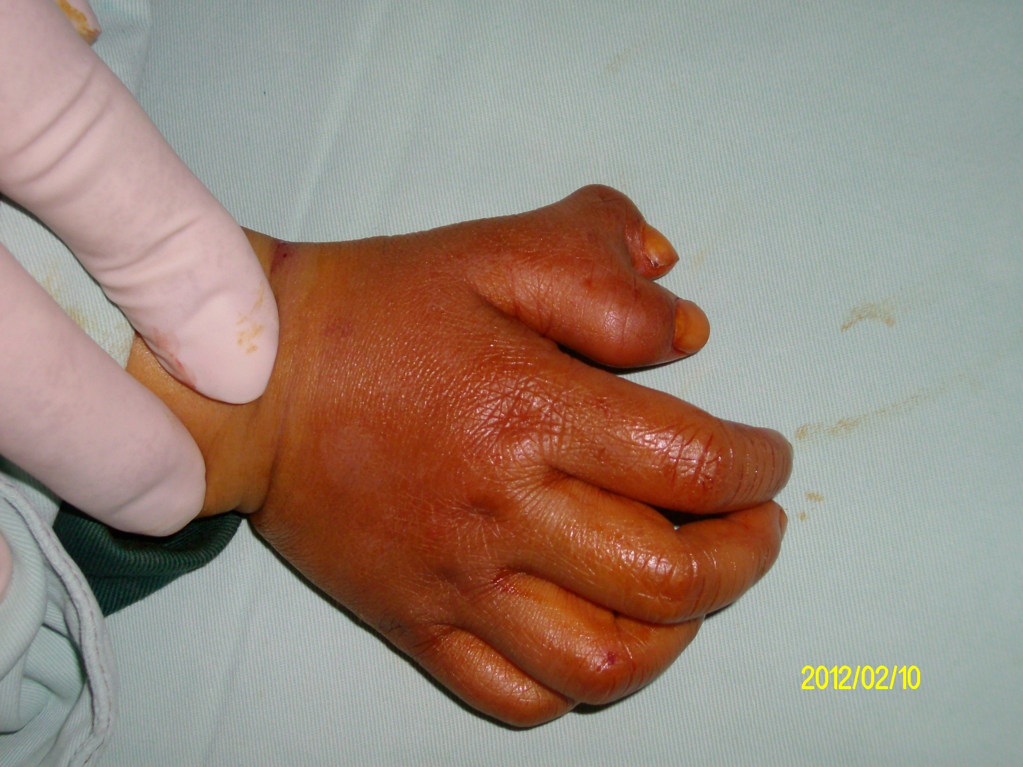 小儿四肢(趾)指先天畸形多大年龄治疗合适? - 好大夫在线