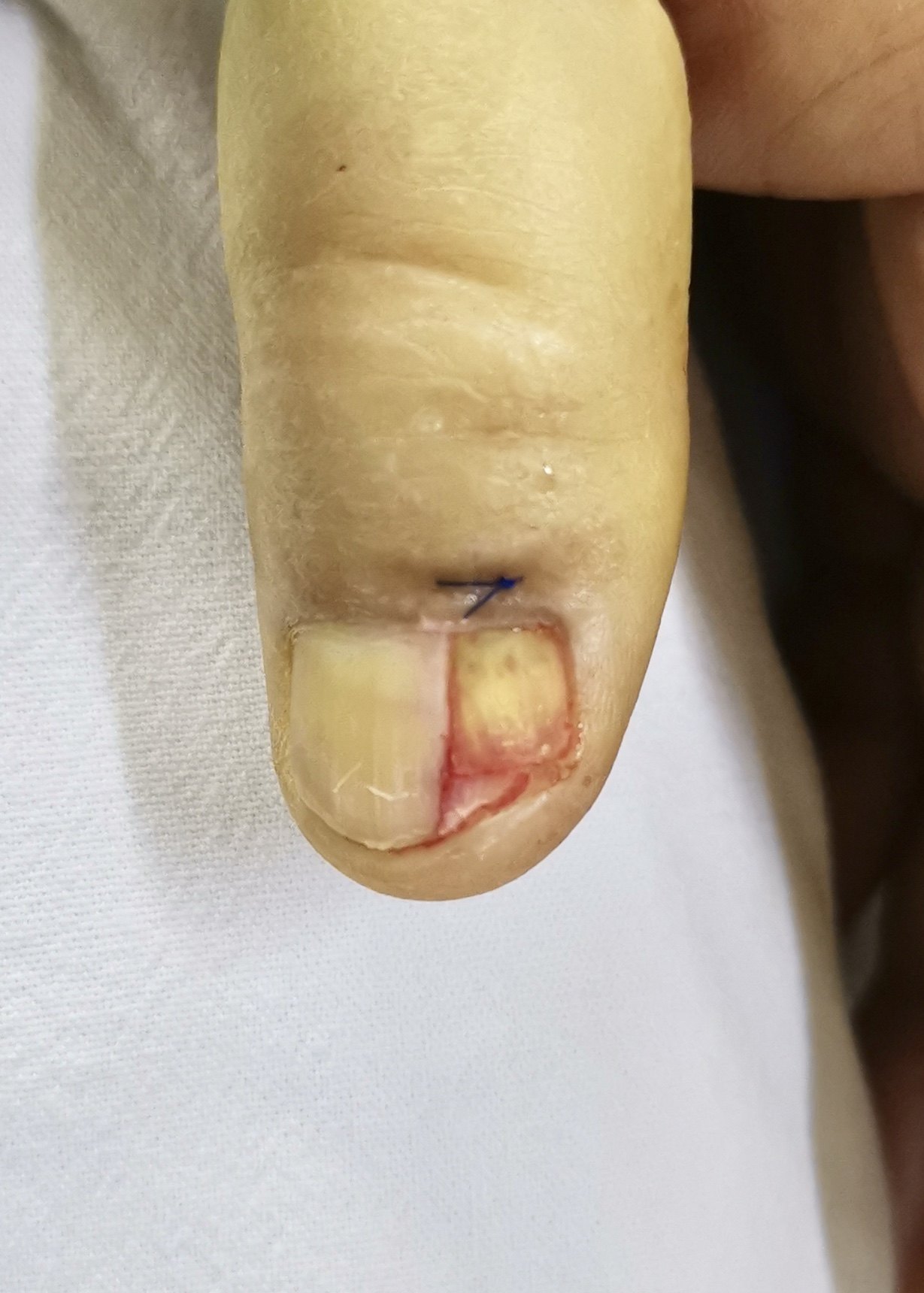指甲盖下有血管瘤图片图片