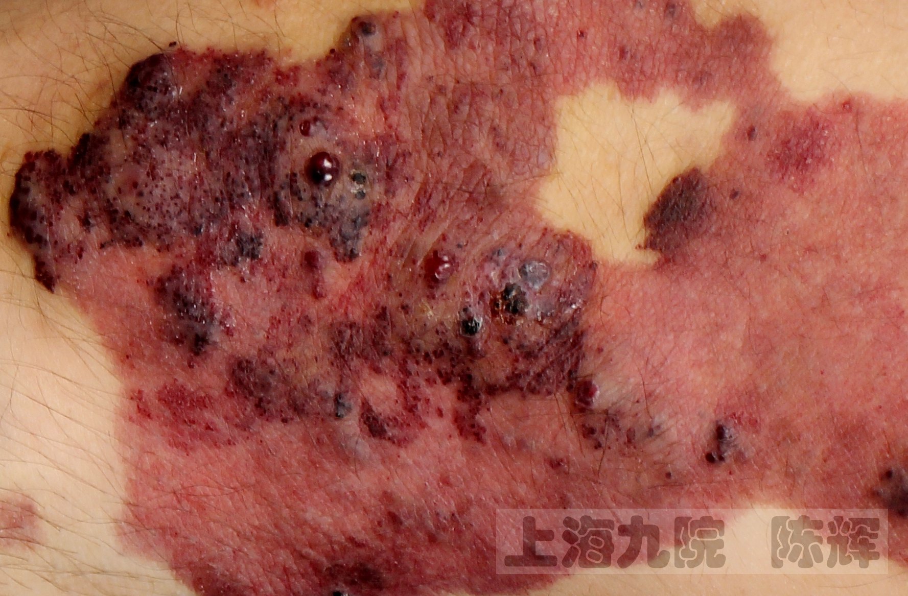阴囊 紫红疙瘩图片