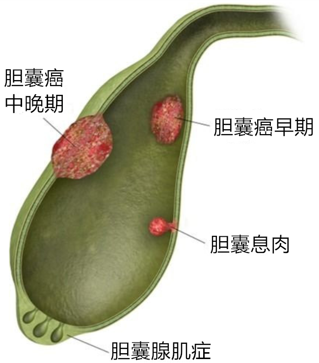 有关胆囊癌的十大常见问题 胆囊癌 疾病介绍 治疗方法 病因 饮食运动