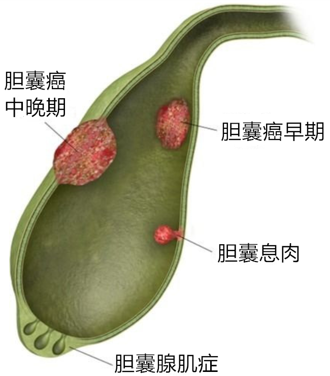 有关胆囊癌的十大常见问题 胆囊癌 疾病介绍 治疗方法 病因 饮食运动 有关胆囊癌的十大常见问题 胆囊癌 疾病介绍 治疗方法 病因 饮食运动