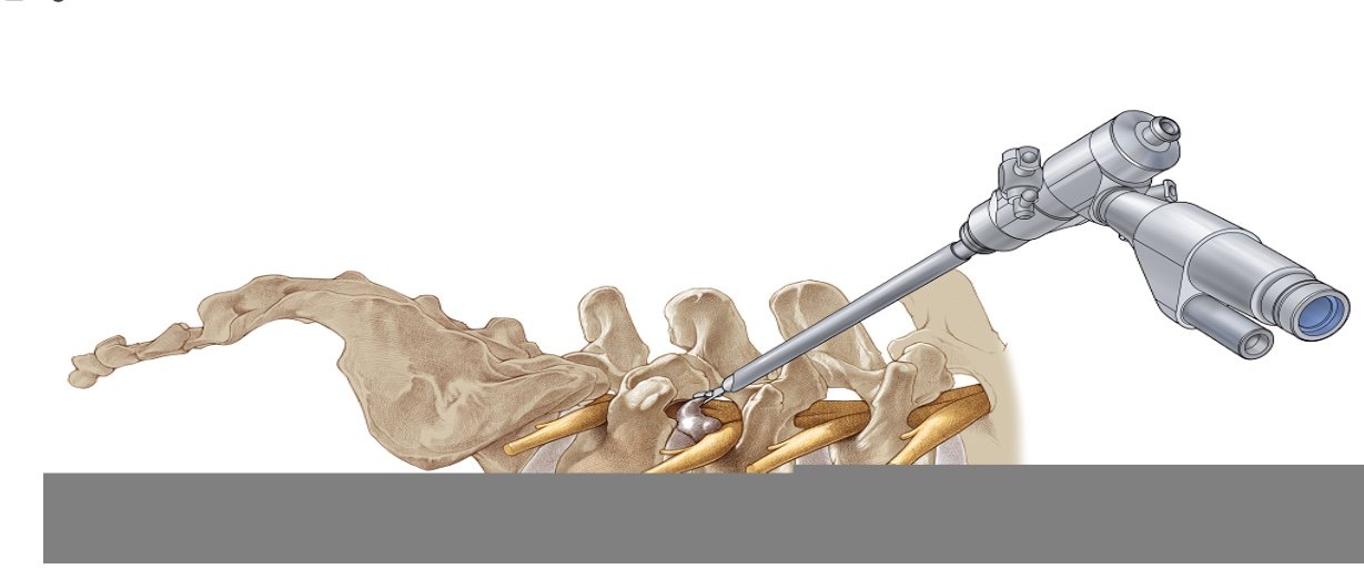 脊柱微创内镜的神奇之旅