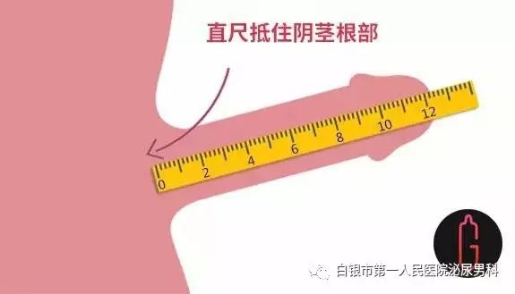 用直尺测量耻骨联合到阴茎头的长度(牵拉后的长度与勃起的长