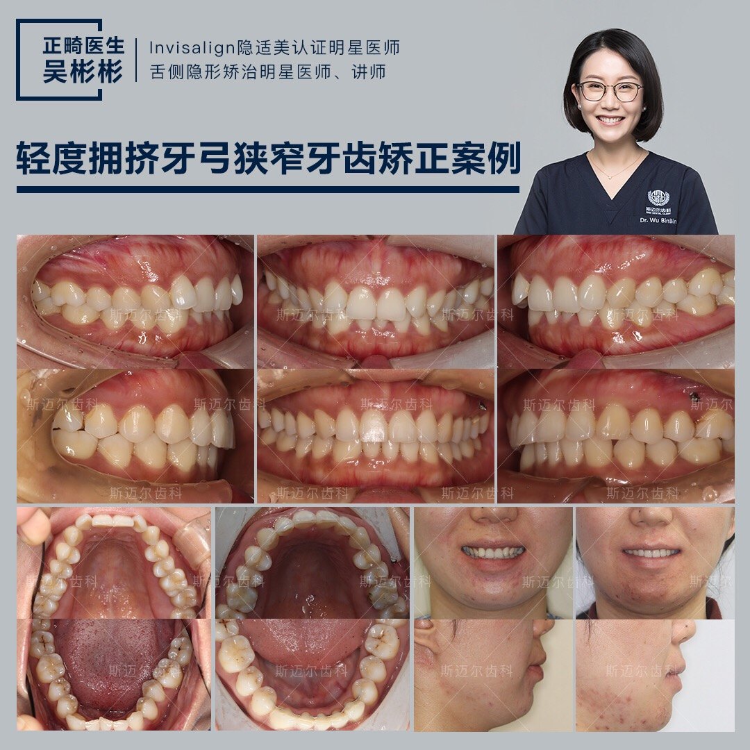 輕度擁擠牙弓狹窄牙齒矯正病例