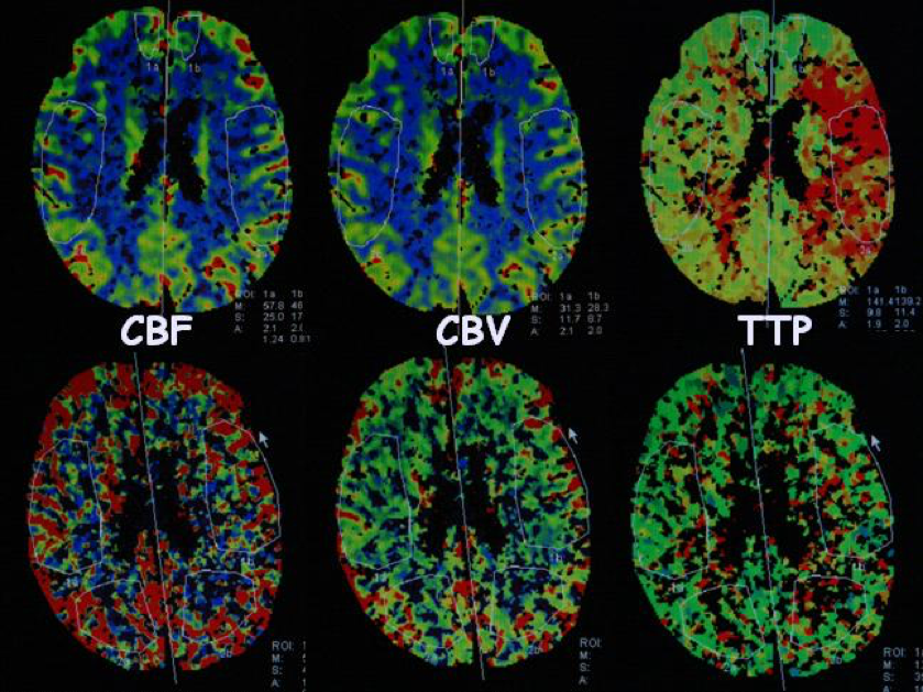 的ct灌注成像,上方为术前,下方为术后,从左到右依次为脑血流量(cbf)