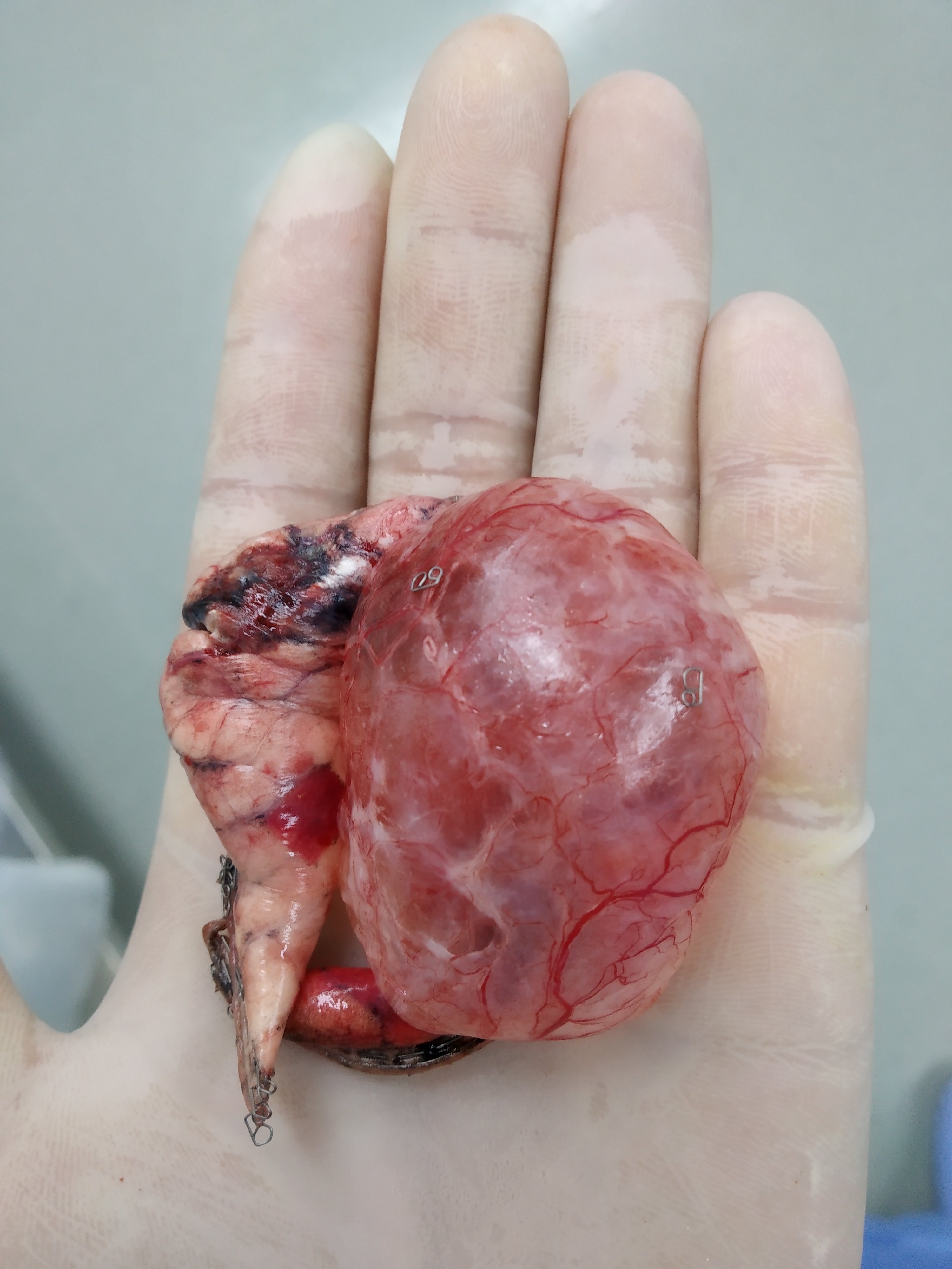 肺大泡手术图片