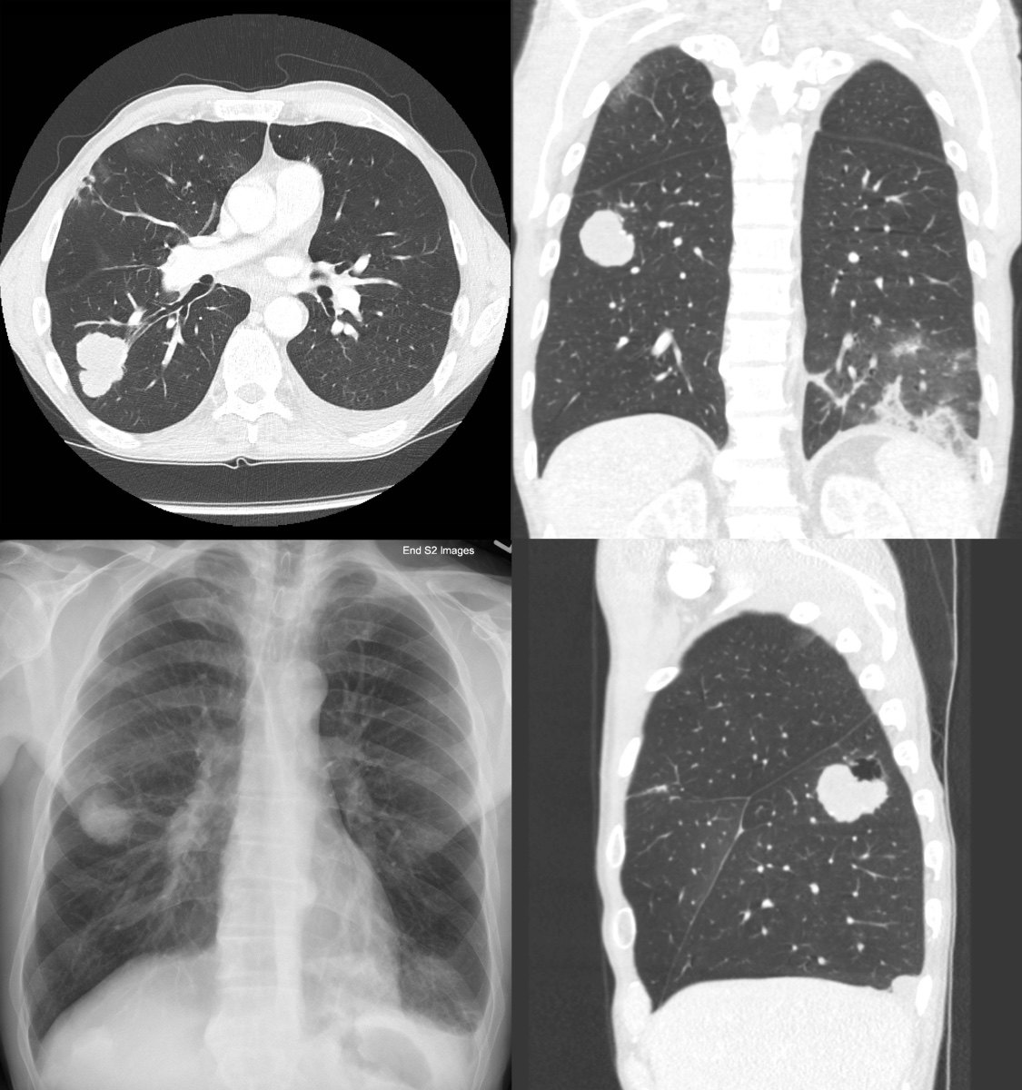 肺结节的x线表现图片图片