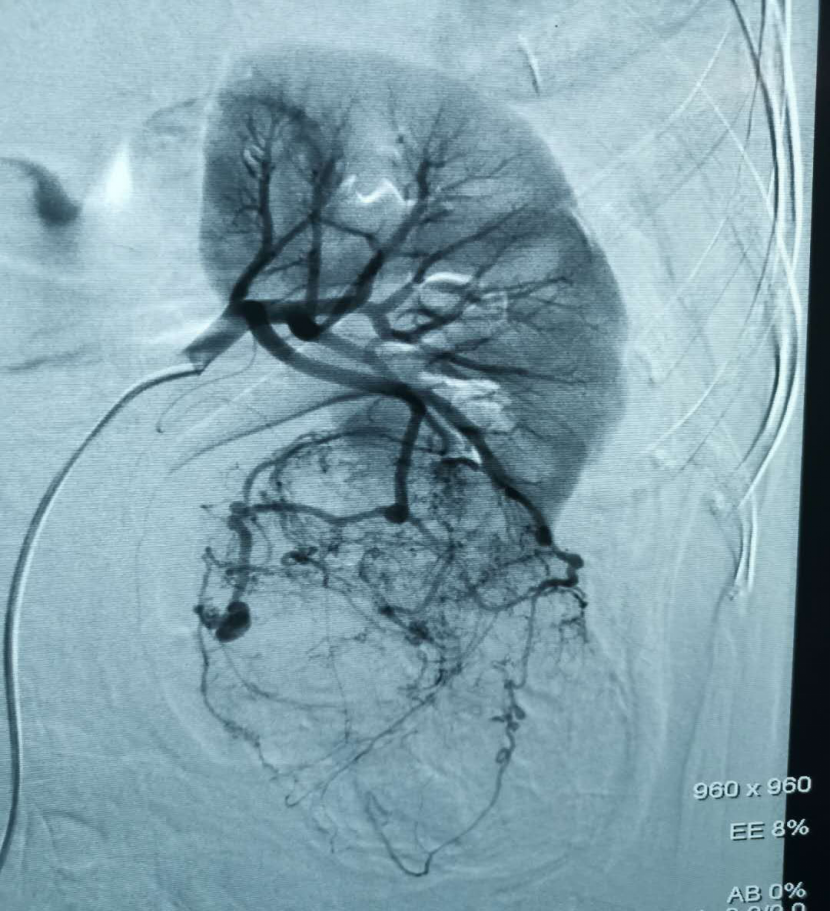 肾脏错构瘤破裂出血介入治疗 肾错构瘤 症状 介入治疗