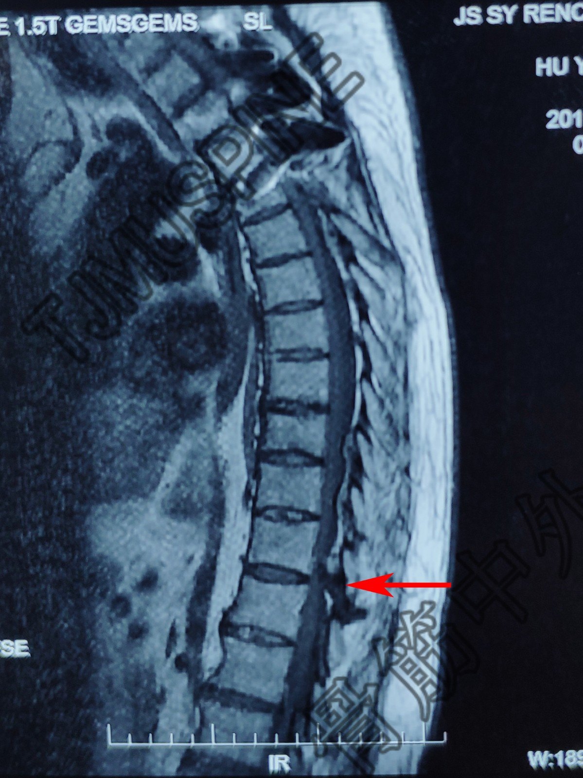 结合上述ct示:t12/l1t11/12t10/11t9/10t8/9ct示胸椎多发黄韧带骨化