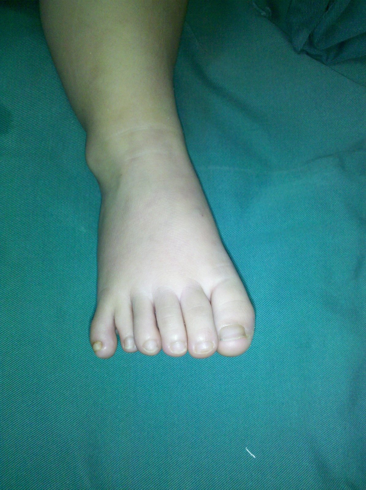 什么是多趾切除术?_先天性并指多指畸形_手术_治疗方式 - 好大夫在线