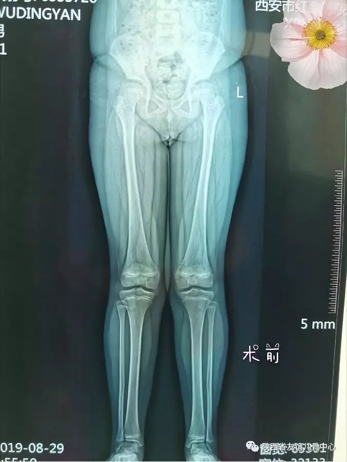 膝盖骨往外偏图片图片