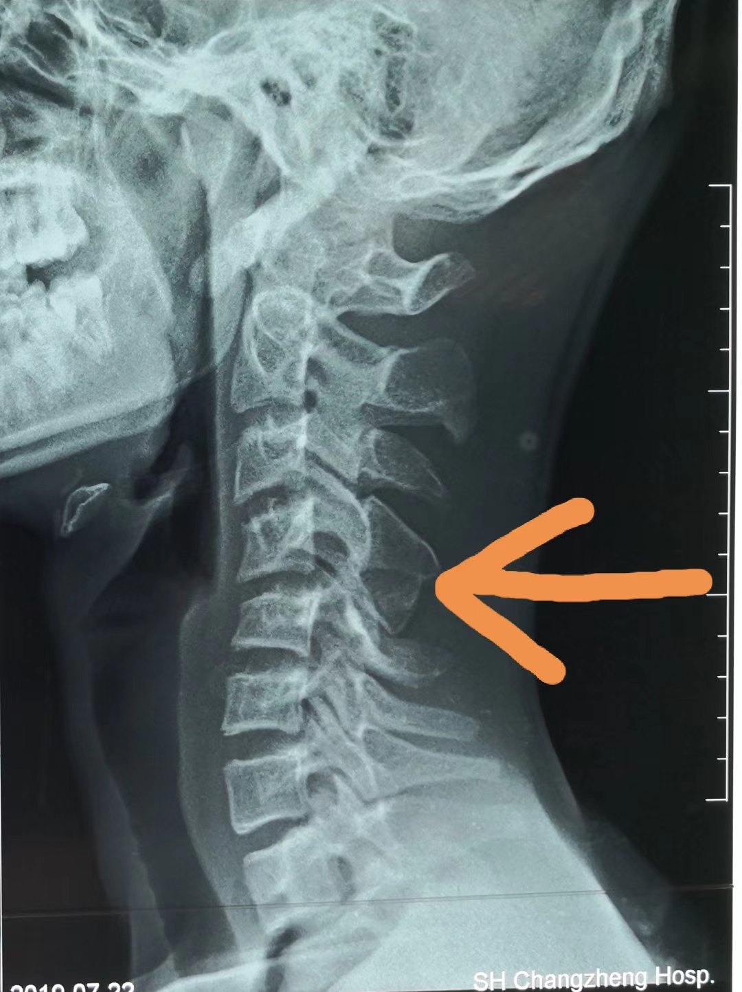 小科普 颈椎反弓 该怎么办 颈椎病 症状 治疗方法 检查 小科普 颈椎反弓 该怎么办 颈椎病 症状 治疗方法 检查