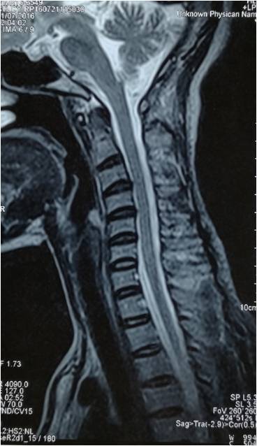 小科普 颈椎反弓 该怎么办 颈椎病 症状 治疗方法 检查 小科普 颈椎反弓 该怎么办 颈椎病 症状 治疗方法 检查