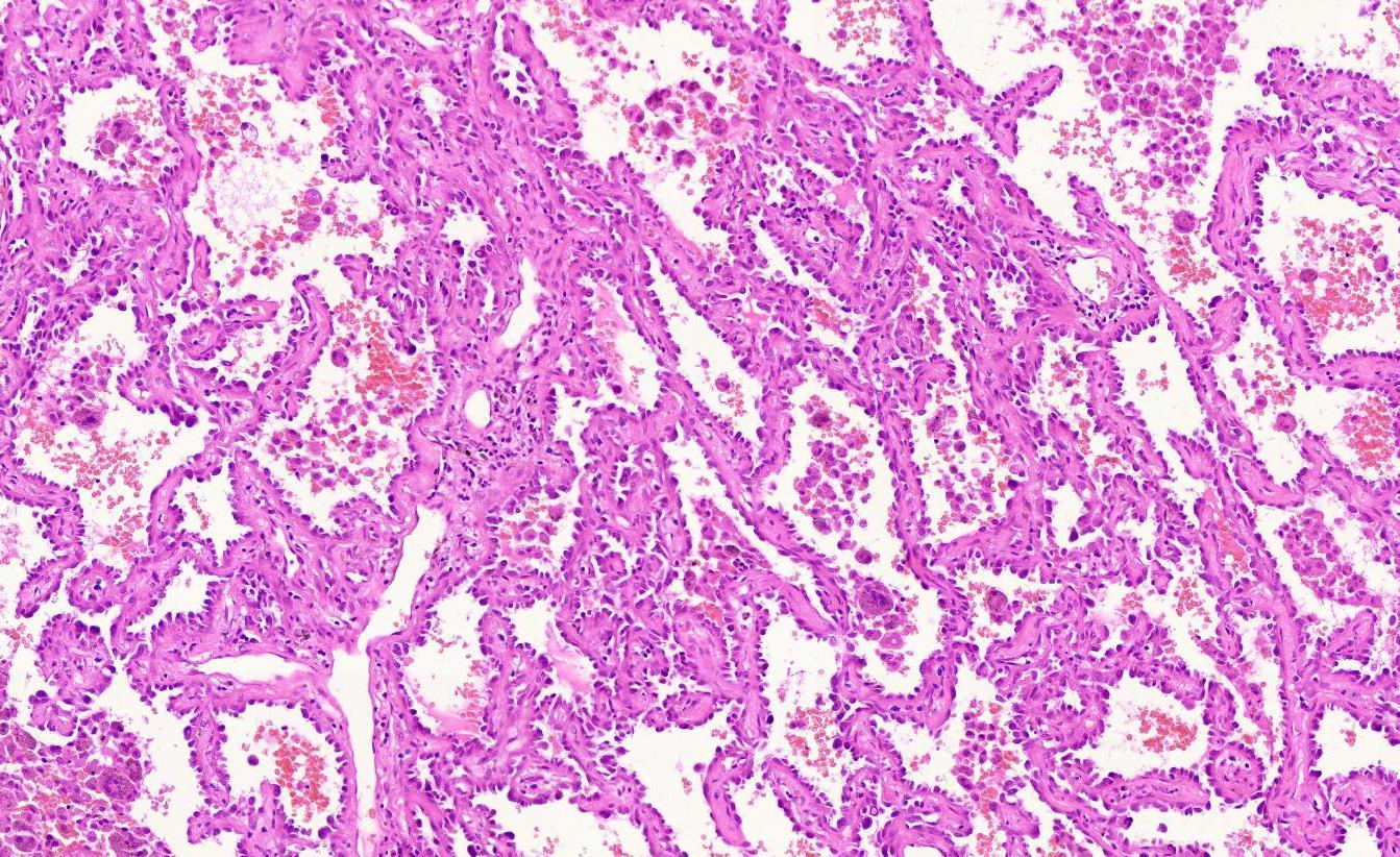 肺小结节(磨玻璃)之原位腺癌的病理诊断(二) - 好大夫在线