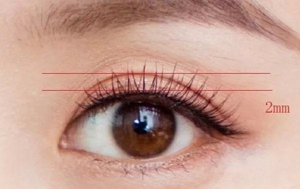 如果你的眼窝凹陷,皮肤松弛, 脂肪多 ,眼裂大,眉眼间距宽,双眼皮