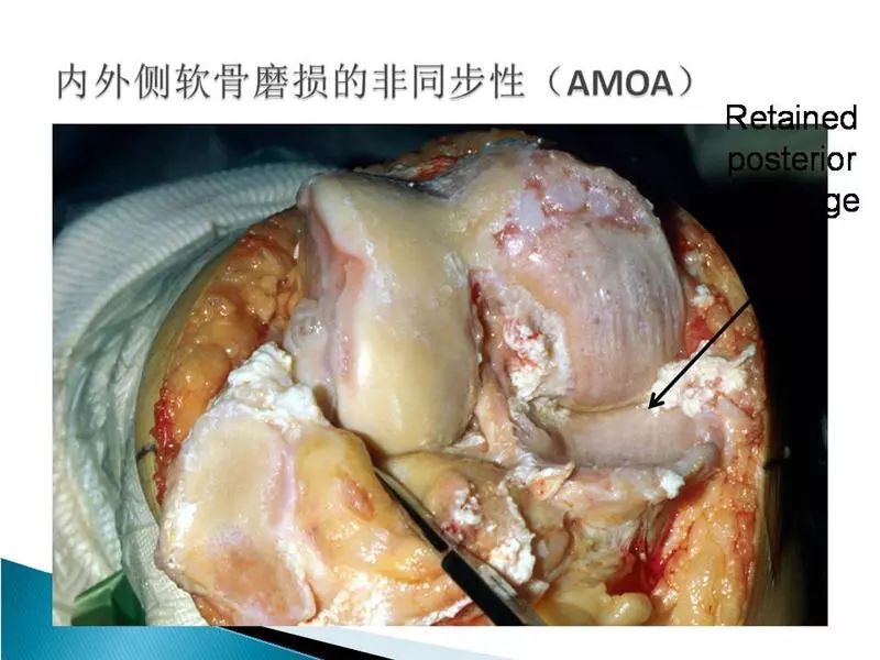 為什麼膝關節骨性關節炎需要階梯治療