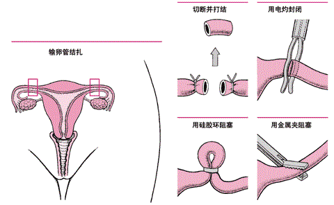 二胎剖宫产