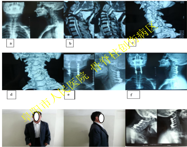 先天性颈椎融合畸形图图片