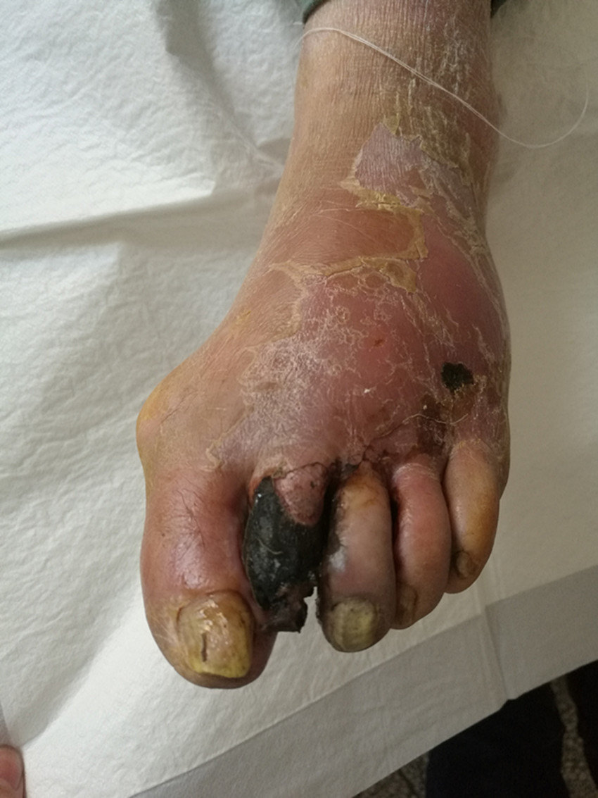 糖尿病足病严重程度的分级