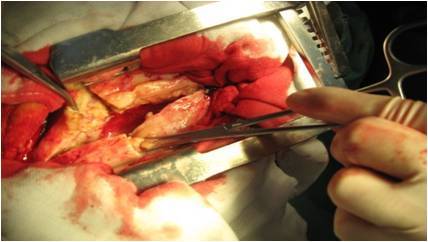 胸膜纤维板剥脱术图片