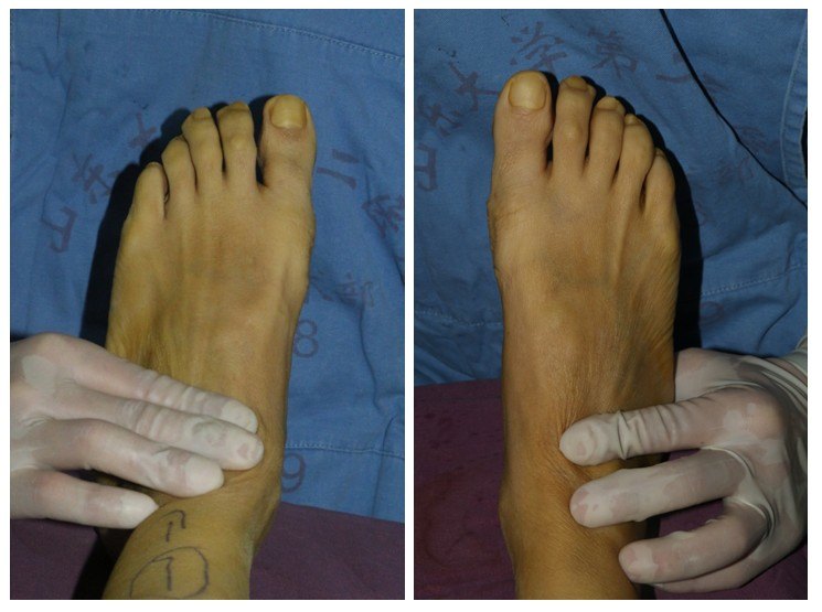 双足拇外翻的手术治疗 - 好大夫在线