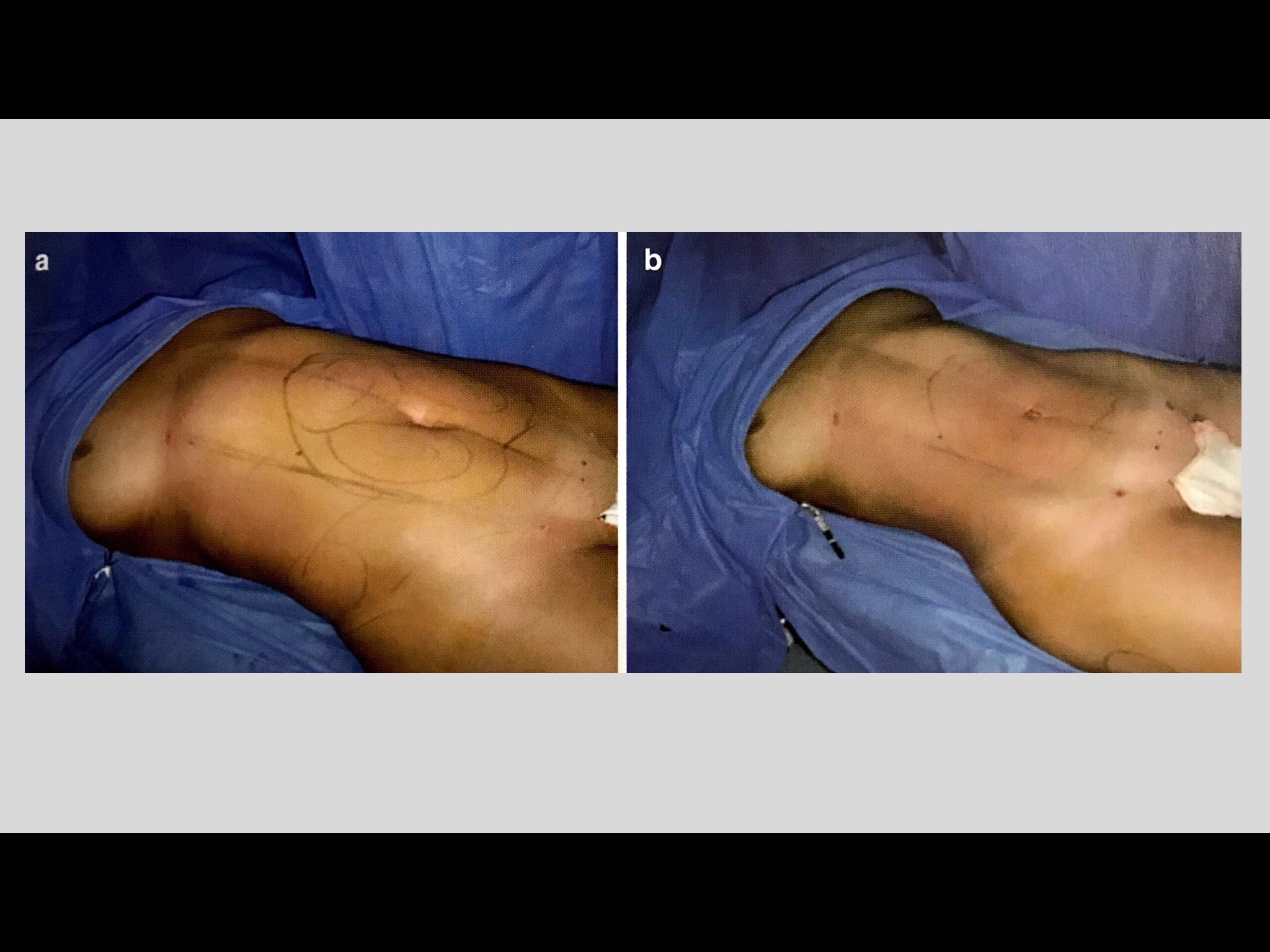 吸脂术是什么?安全吗?有效吗?会反弹吗? - 好大夫在线