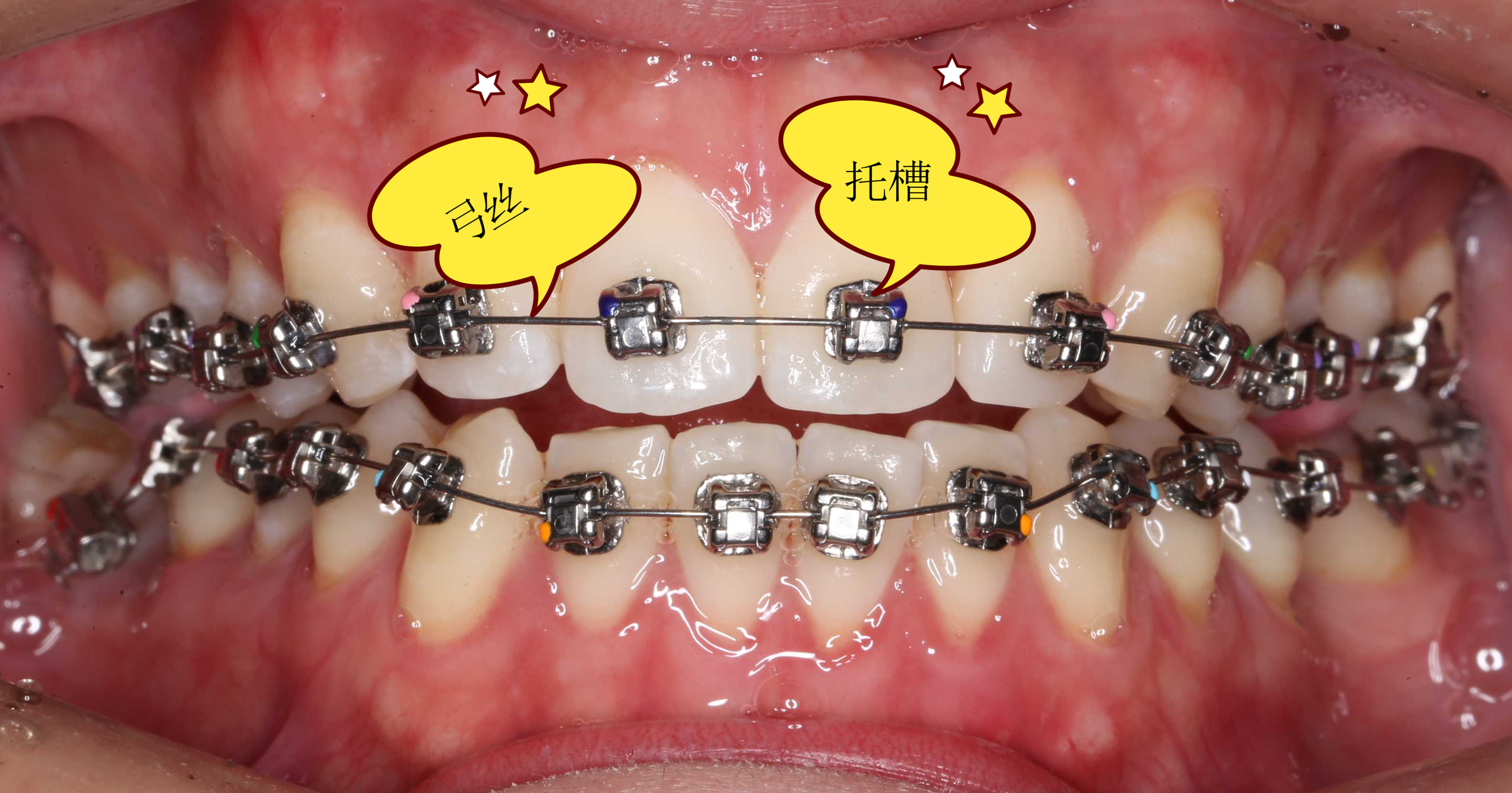 箍牙的各种小部件,求知欲爆棚的你可以了解一下!