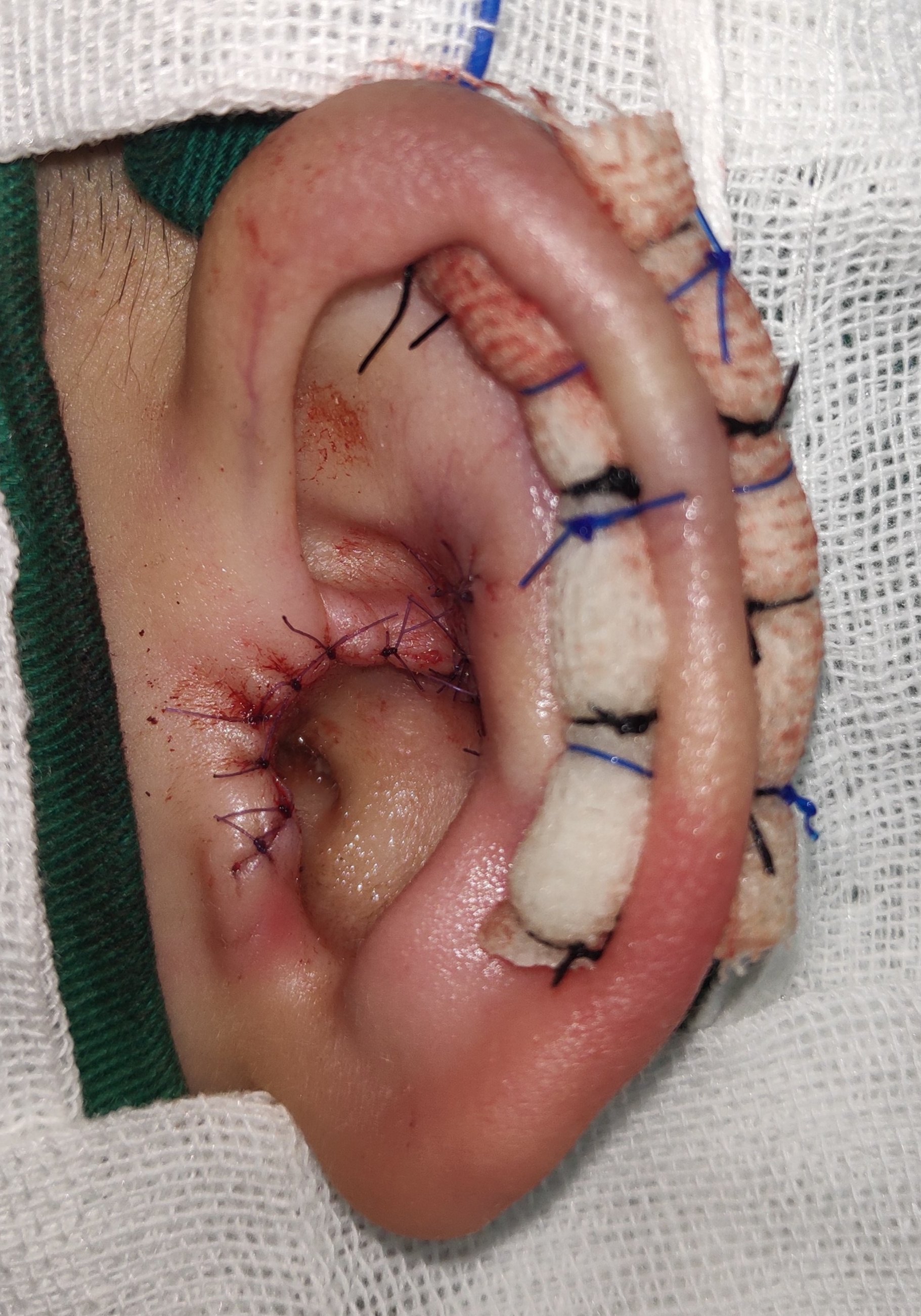 秦昊医生手记～耳廓畸形矫正手术 - 好大夫在线