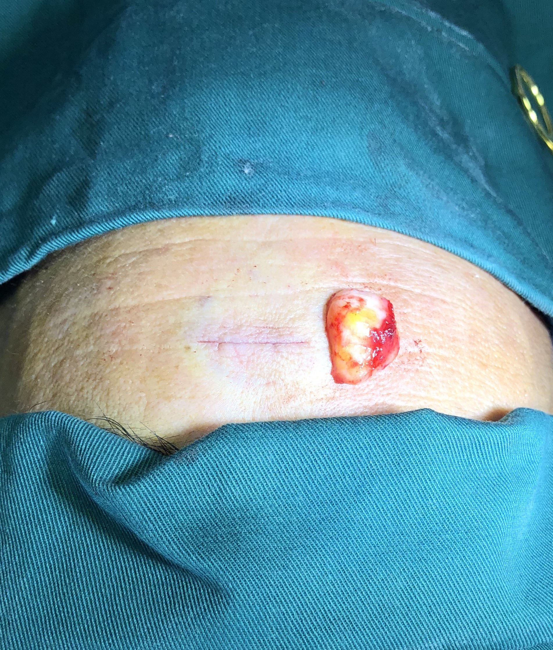 脂肪瘤拆线后的图片图片