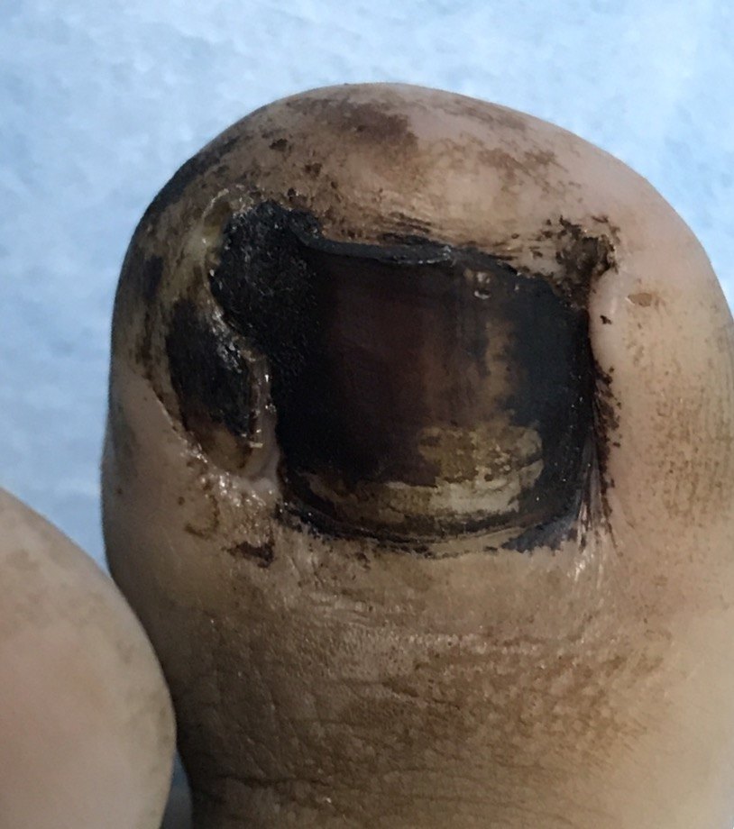 嵌甲的激光治疗 - 好大夫在线